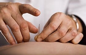 acupuncture hands